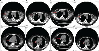 Therapeutic Effect of CAOLD Chemotherapy Regimen on Patients With Relapsed/Refractory Angioimmunoblastic T-Cell Lymphoma: A Case Study